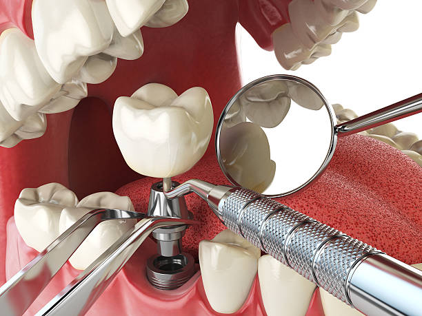 Best Emergency Root Canal Treatment in Stratford Downtown, CT